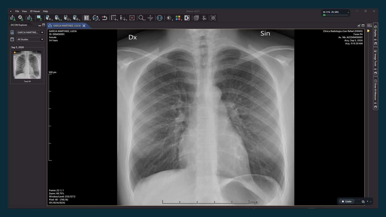 Visor web con una radiografía de tórax abierta desde el navegador. Estudio de demostración, sin ningún paciente real.